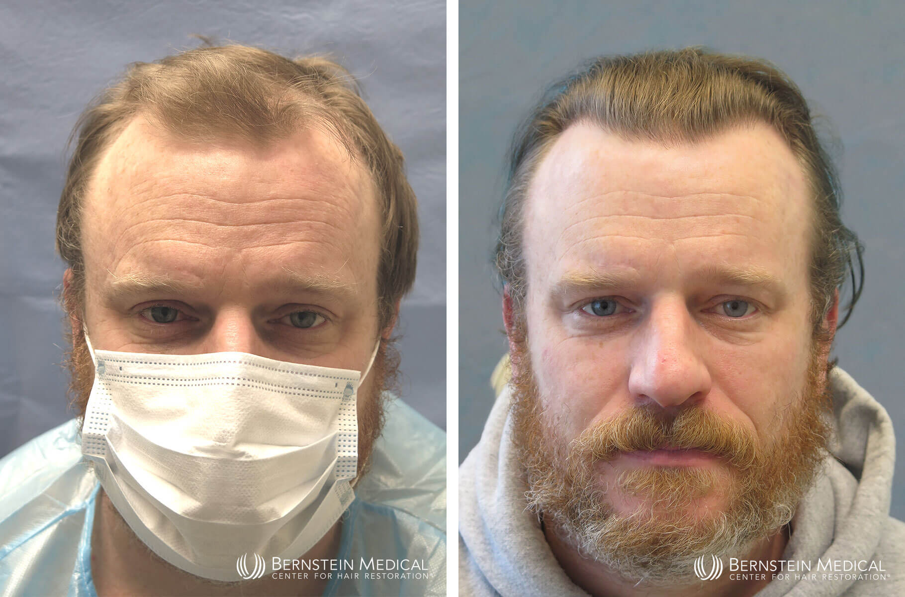 Bernstein Medical - Patient KLD Before and After Hair Transplant Photo 