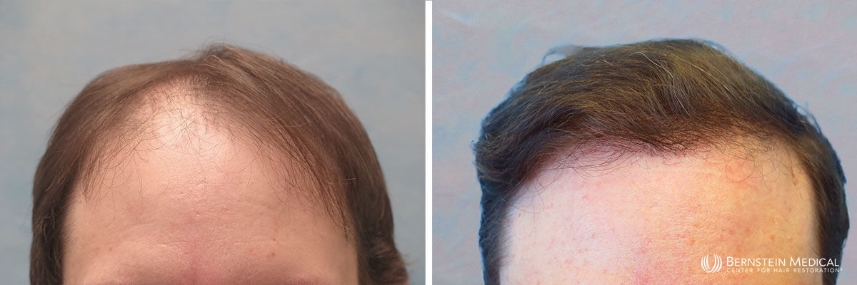 Bernstein Medical - Patient ZAM Before and After Hair Transplant Photo 