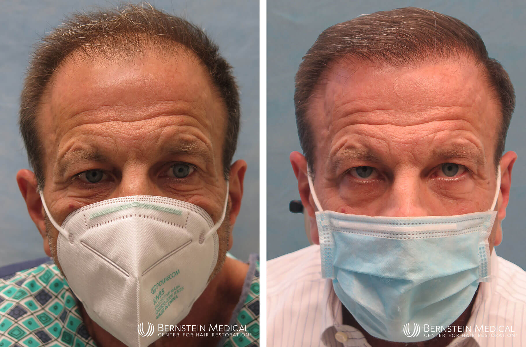Bernstein Medical - Patient CKI Before and After Hair Transplant Photo 
