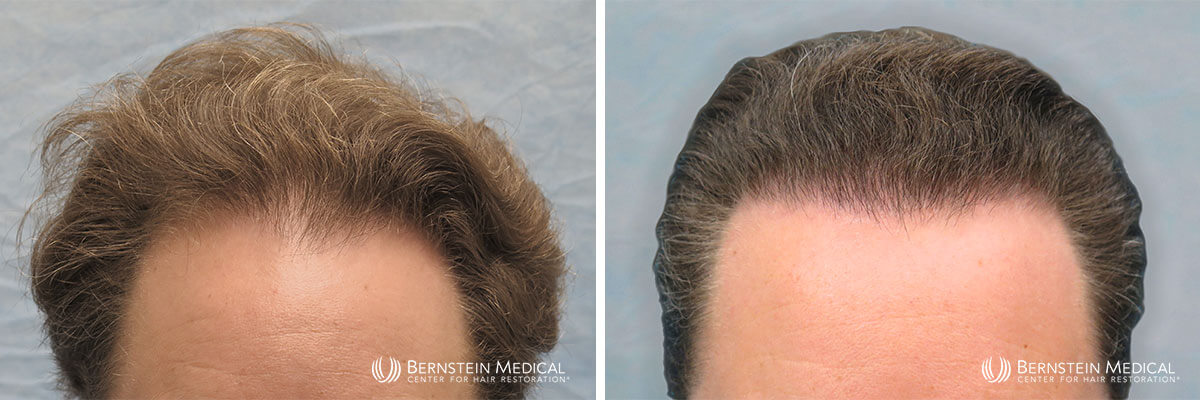 Bernstein Medical - Patient FBZ Before and After Hair Transplant Photo 