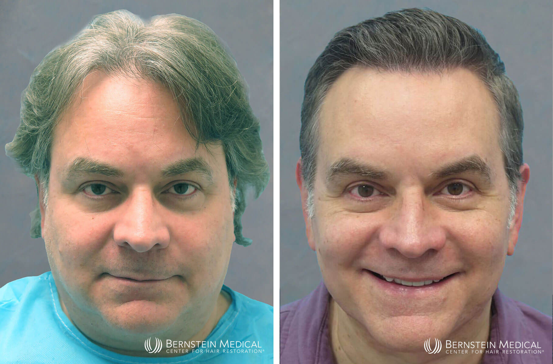 Bernstein Medical - Patient GTF Before and After Hair Transplant Photo 