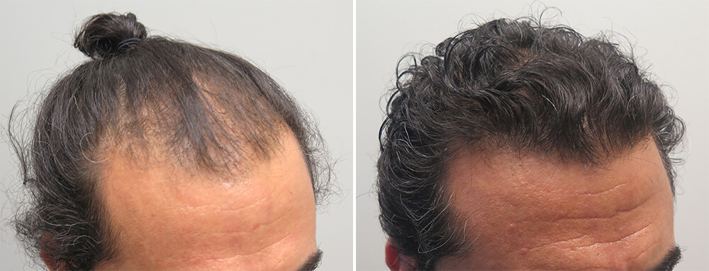 finasteride hair loss effectiveness