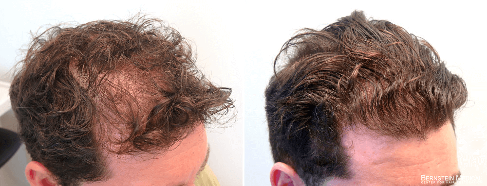 ramme kredsløb Montgomery Propecia Rogaine Before After Photos | Bernstein Medical