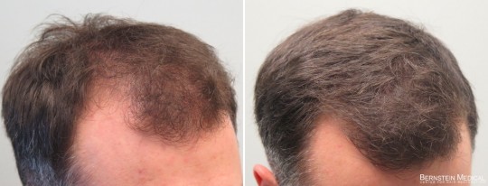 Patient AWS - 28 y/o male before treatment (left); after 1 year on finasteride 1mg/day and Rogaine (minoxidil) solution 5% PM (right)