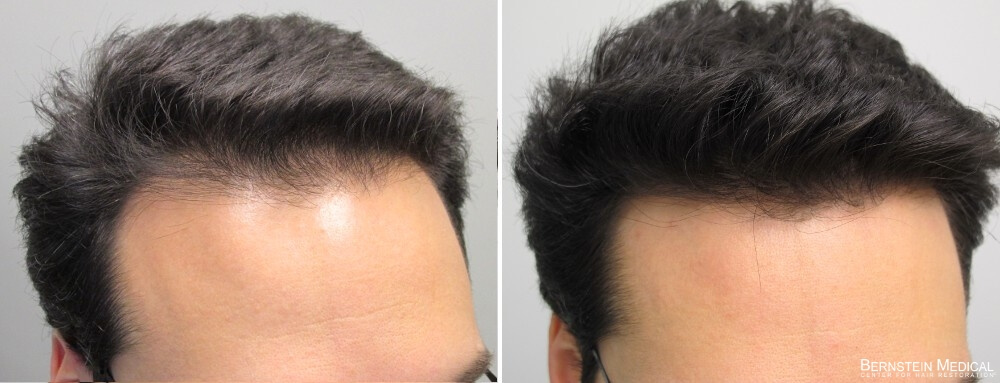 Se puede tomar finasteride y minoxidil a la vez