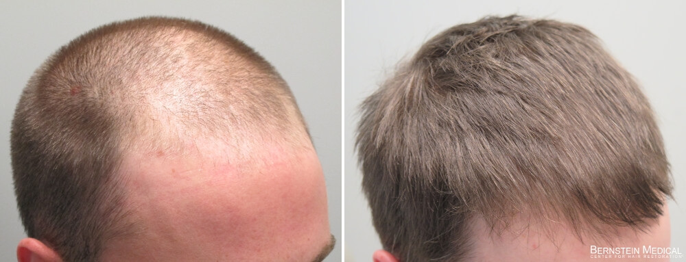 After 3 years and 3 months on Finasteride 1.25mg daily, and Rogaine (minoxi...