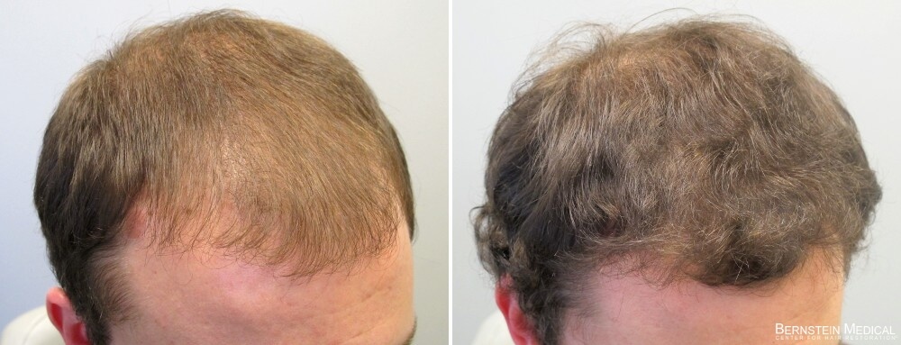 Propecia Rogaine Before After Photos | Medical