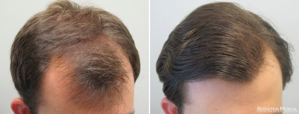 Propecia Rogaine Before After Photos | Bernstein Medical