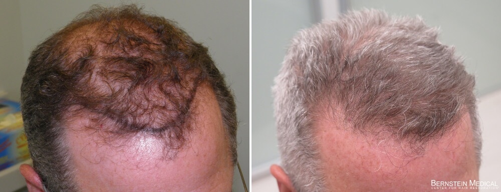 finasteride 1 year no results reddit