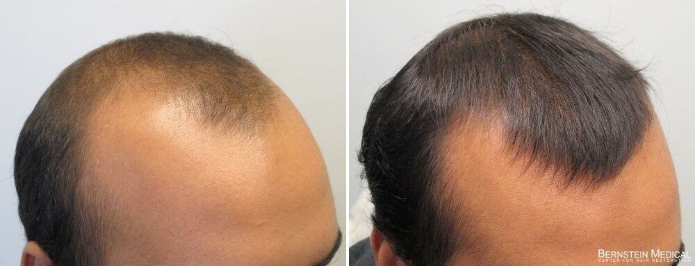 After 1 year on finasteride 1.25mg/day and Rogaine (minoxidil) solution 5% ...