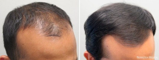 Patient ILM - 37 y/o male before treatment (left); after 11 months on finasteride 1mg/day and Rogaine (minoxidil) solution 5% PM (right)