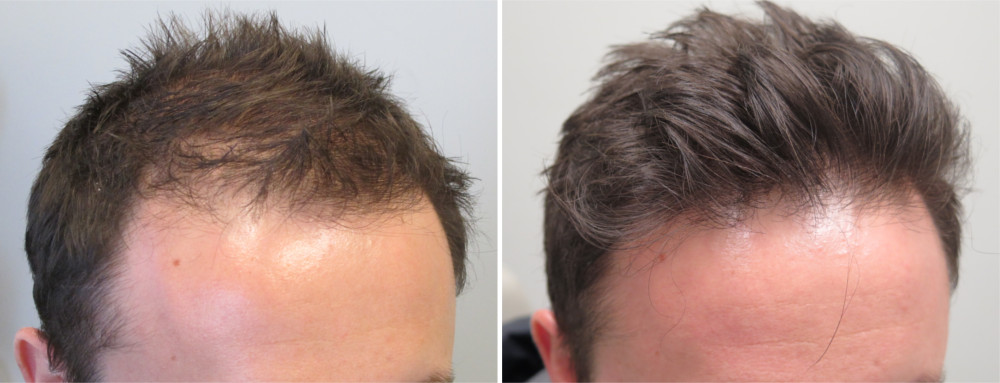 Propecia Rogaine Before After Photos | Medical