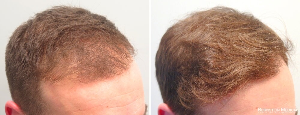 Minoxidil finasterid Finasteride and