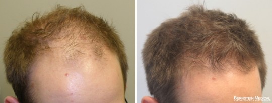 Patient OVQ - 34 y/o male before treatment (left); after 5 years on finasteride 1.25mg/day and Rogaine (minoxidil) solution 5% PM (right)