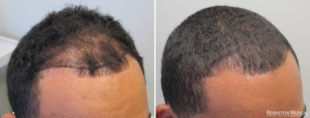 finasteride 1mg results reddit