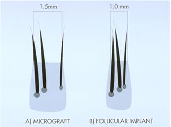 Micrograft vs Follicular Implant