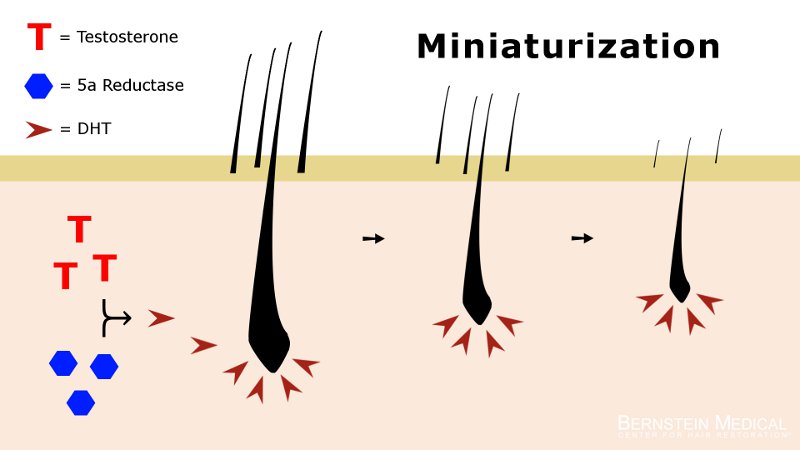 Miniaturization: Cause of Hair Loss | Bernstein Medical