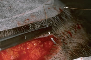 A New Suture for Hair Transplantation - Suturing technique showing a simple running stitch