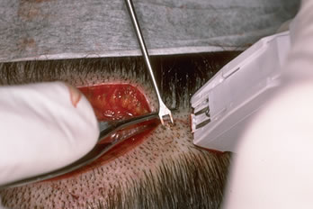 A New Suture for Hair Transplantation - Suturing technique showing a simple running stitch