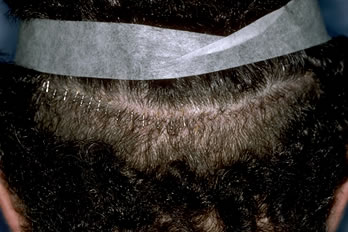 A New Suture for Hair Transplantation - Appearance of a typical closure at 12-days post-op