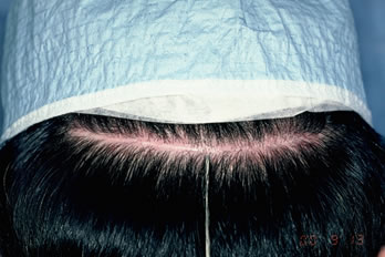 A New Suture for Hair Transplantation - Midline view of a patient with a wider scar on the staples side