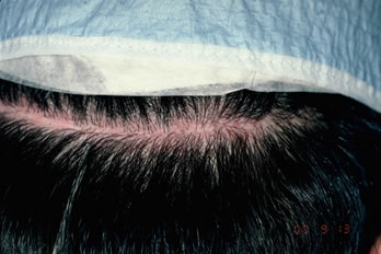 A New Suture for Hair Transplantation - Detail of right side (sutures) showing a fine, ill-defined scar