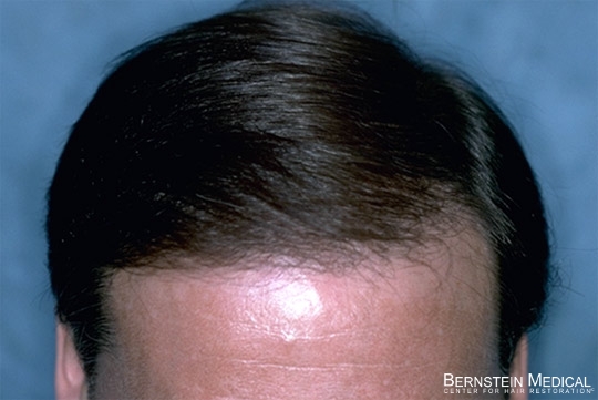 Camouflage: Hair Transplant Repair | Bernstein Medical
