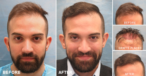 Hair Transplant Surgery: Types, Candidacy, The Procedure, and More | Bernstein Medical Hair Transplant Surgery: Types, Candidacy, The Procedure, and More | Bernstein Medical
