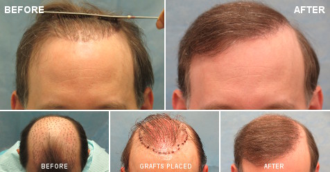 Before and after hair transplant Step-by-Step Situation - Desmoderm