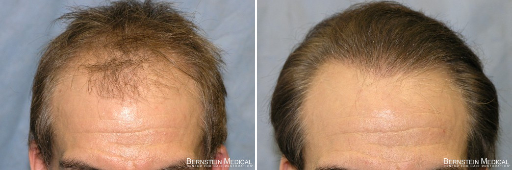 Hair Transplant Photos: Results Timeline | Bernstein Medical Hair Transplant Photos: Results Timeline | Bernstein Medical