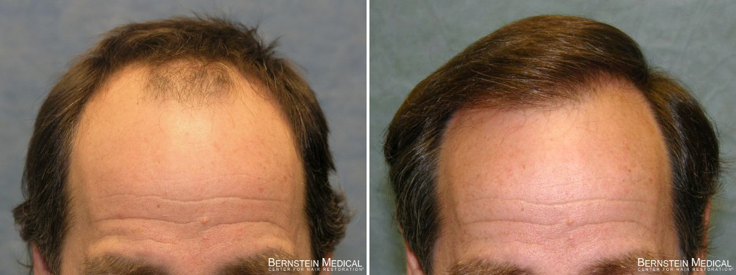 Hair Loss Treatment | Prevent Hair Loss | Bernstein Medical