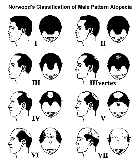 Norwood hair Loss diagram