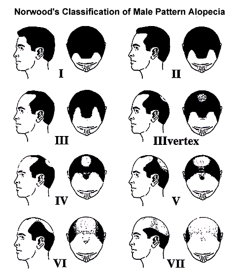 Hair Transplant Graft Chart