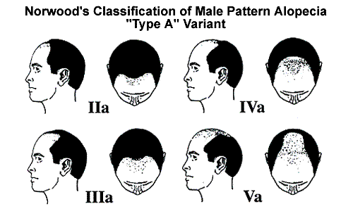 Hairline Chart