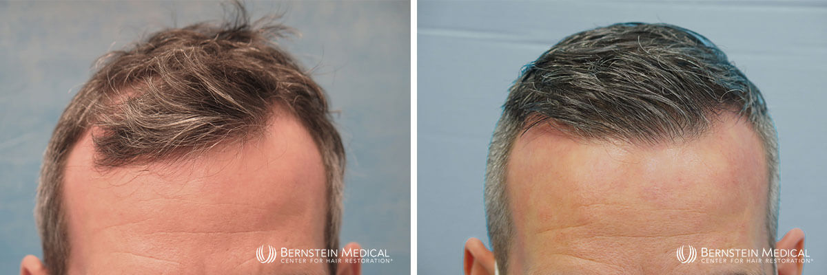 Bernstein Medical - Patient DXL Before and After Hair Transplant Photo 