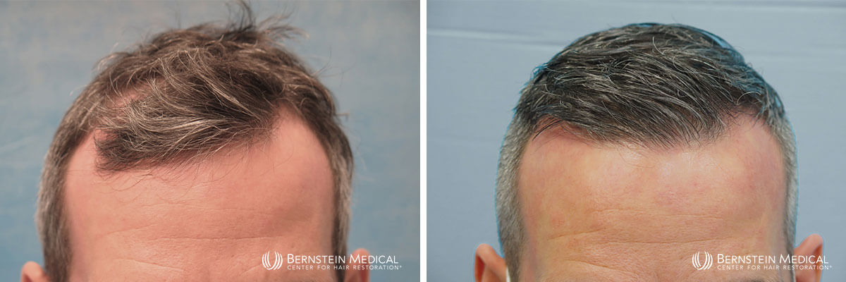 Bernstein Medical - Patient DXL Before and After Hair Transplant Photo