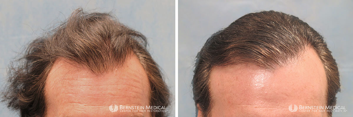 Bernstein Medical - Patient ZCA Before and After Hair Transplant Photo 