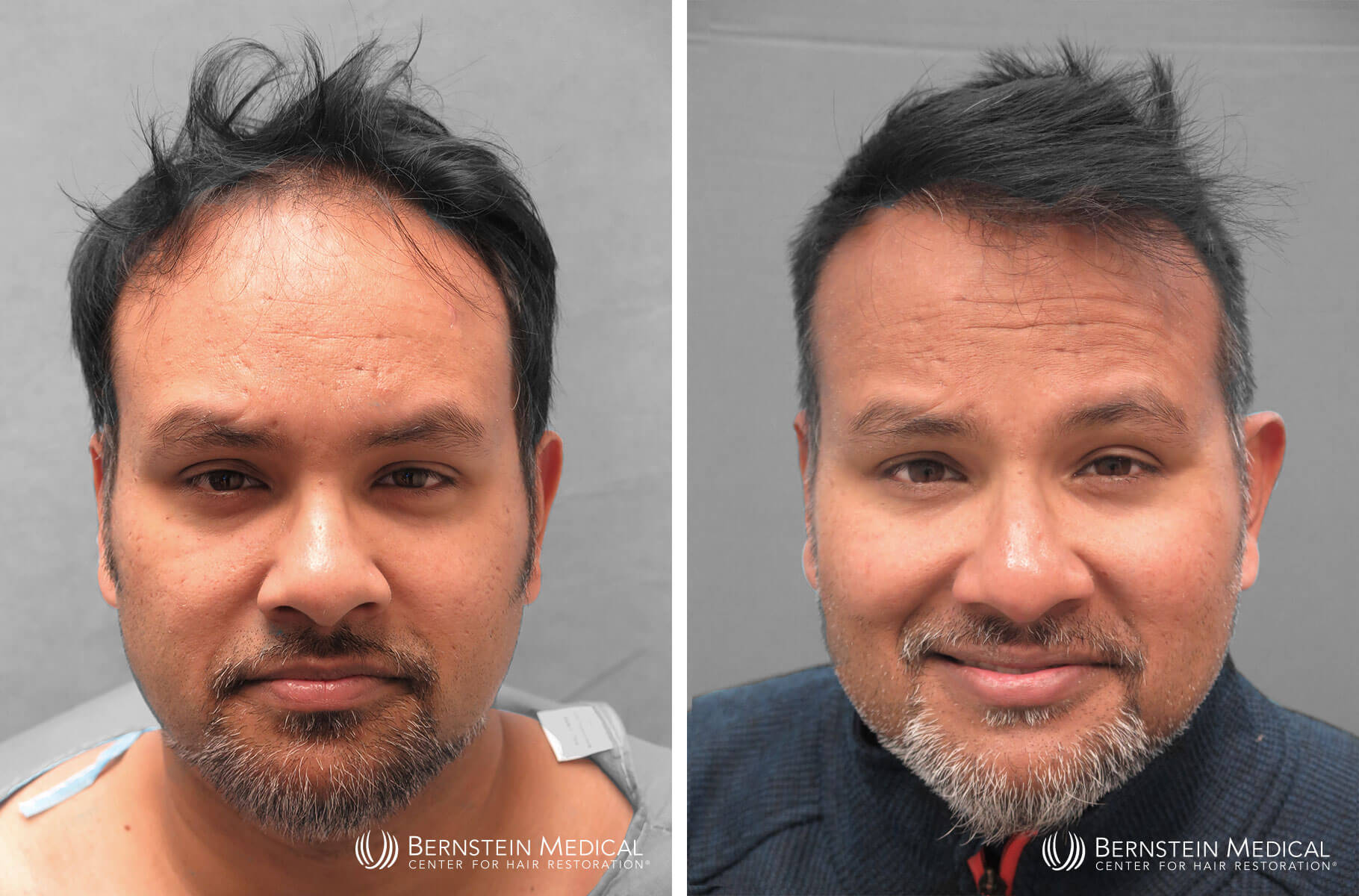Bernstein Medical - Patient RBJ Before and After Hair Transplant Photo 