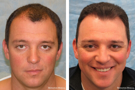 Patient JAZ before and after hair transplant photo