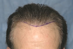 Second Hair Transplant - Hairline Position Marked