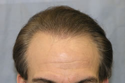 3 Weeks After 2nd Hair Transplant