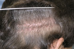 3 Weeks After 2nd Hair Transplant - Line Scar Healing