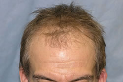 Before Hair Transplant Surgery