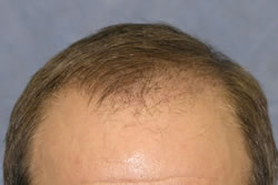 Hair Transplant Photos: Results Timeline | Bernstein Medical