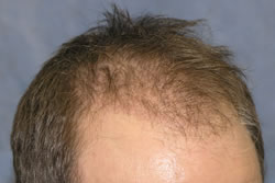 2 Weeks After Hair Transplant - Angle View