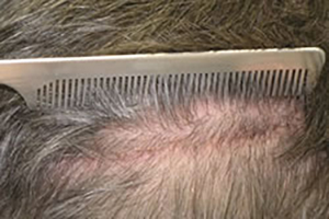 2 Weeks After Hair Transplant - Donor Area Incision