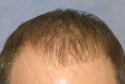 2 Weeks After Hair Restoration Surgery