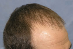 2 Weeks After Hair Restoration Surgery - Side View