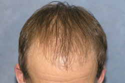 2 Months After Hair Restoration