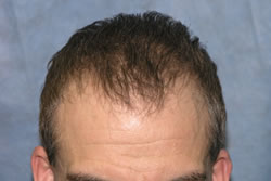 6 1/2 Months After Hair Transplantation